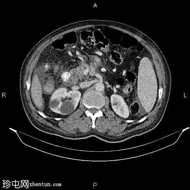 转移性胰腺导管腺癌