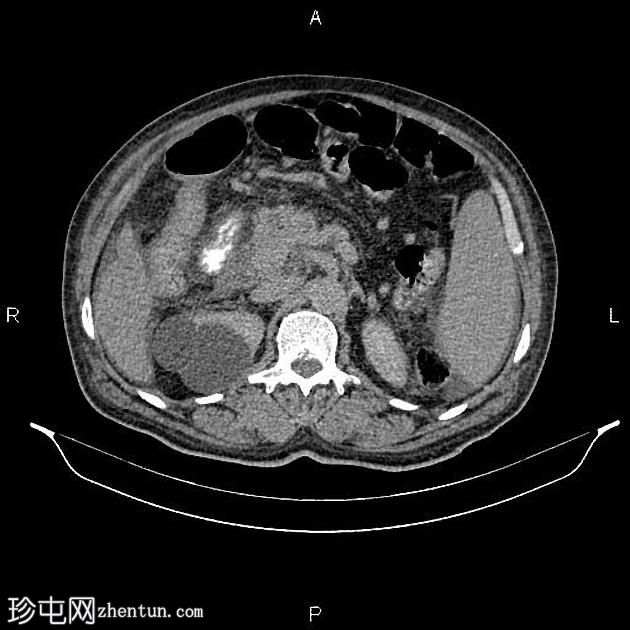 转移性胰腺导管腺癌