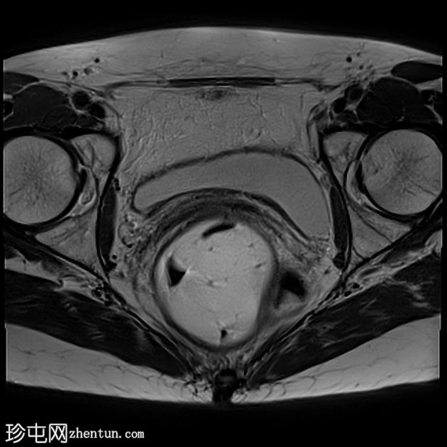 多部位脱垂的 MRI 排便造影