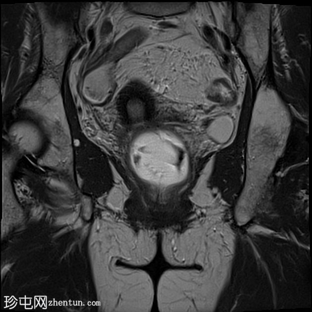 多部位脱垂的 MRI 排便造影