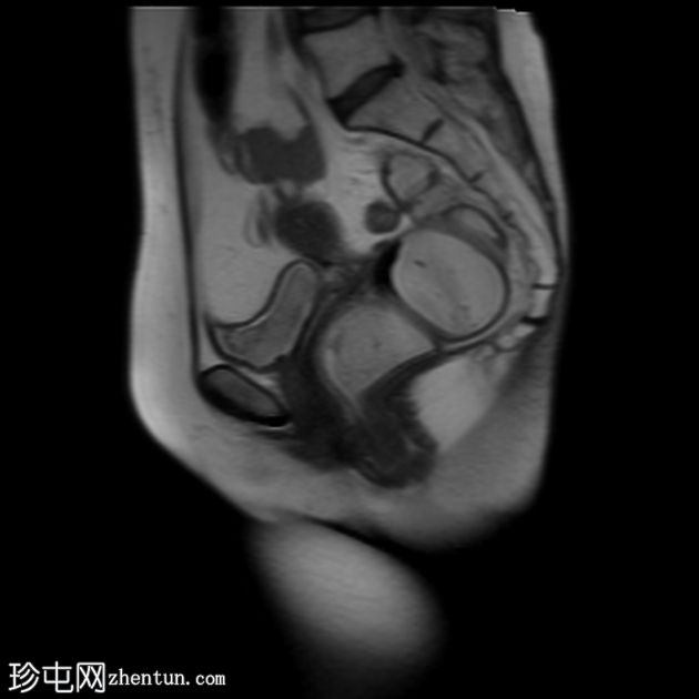 多部位脱垂的 MRI 排便造影