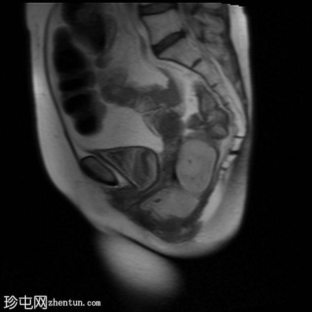 多部位脱垂的 MRI 排便造影