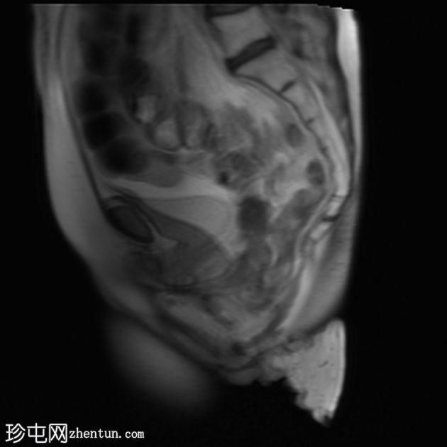 多部位脱垂的 MRI 排便造影