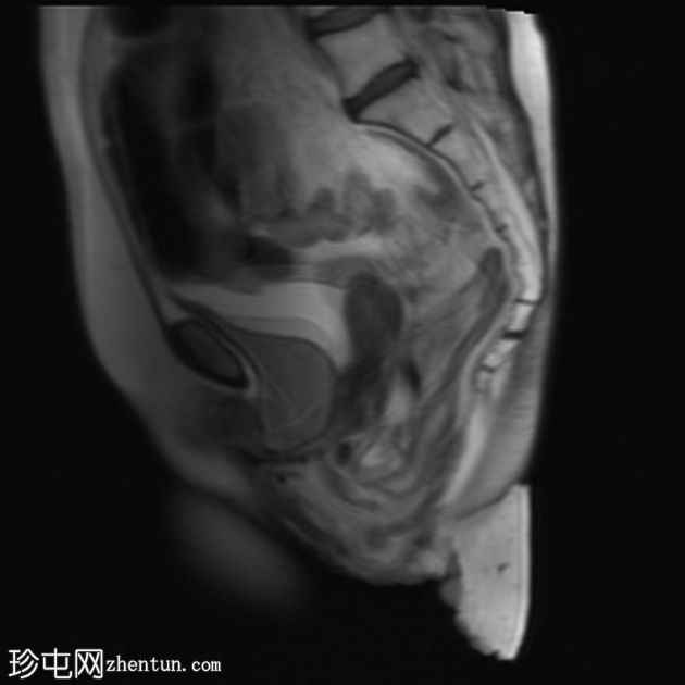 多部位脱垂的 MRI 排便造影