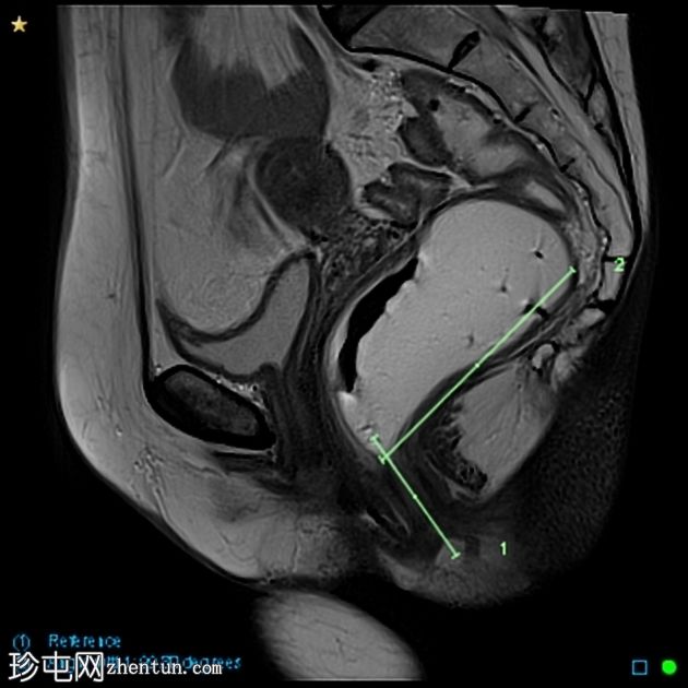 多部位脱垂的 MRI 排便造影