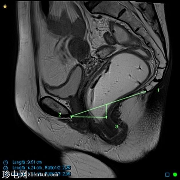 多部位脱垂的 MRI 排便造影