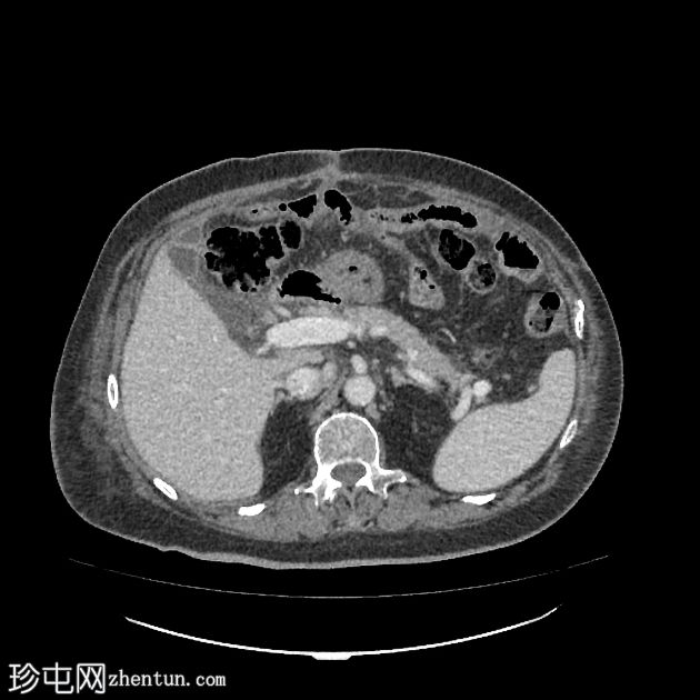 术后腹部脂肪坏死