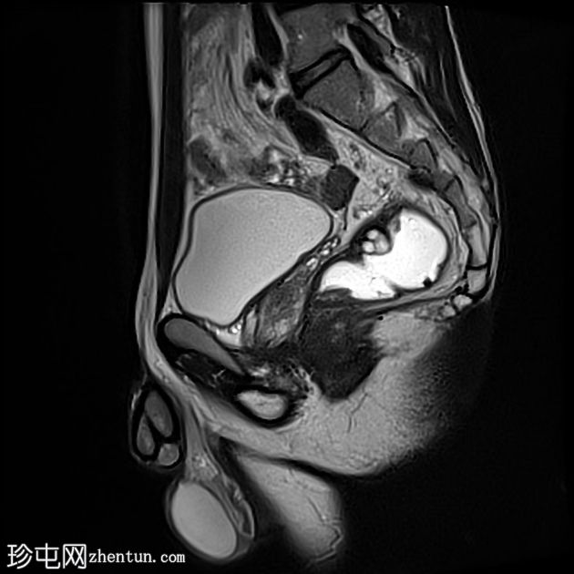 深部囊性结肠炎