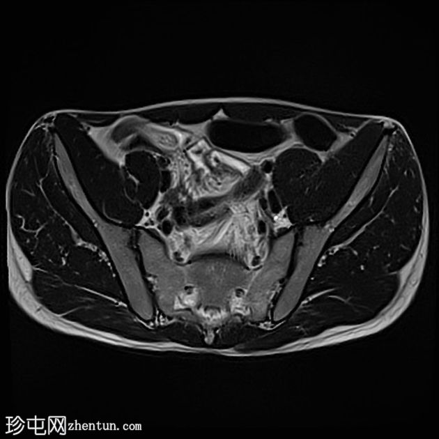 深部囊性结肠炎