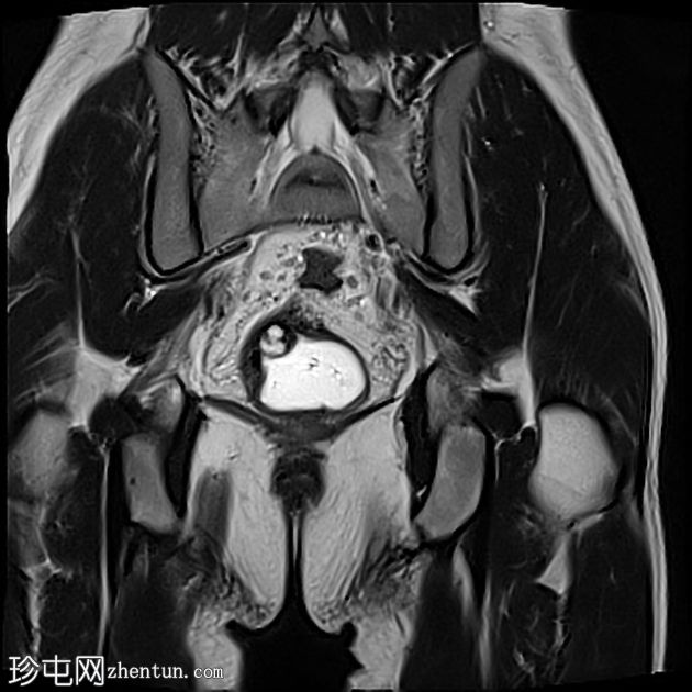 深部囊性结肠炎