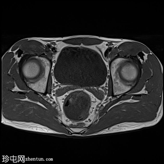 深部囊性结肠炎