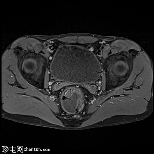 深部囊性结肠炎