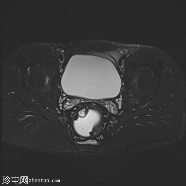 深部囊性结肠炎