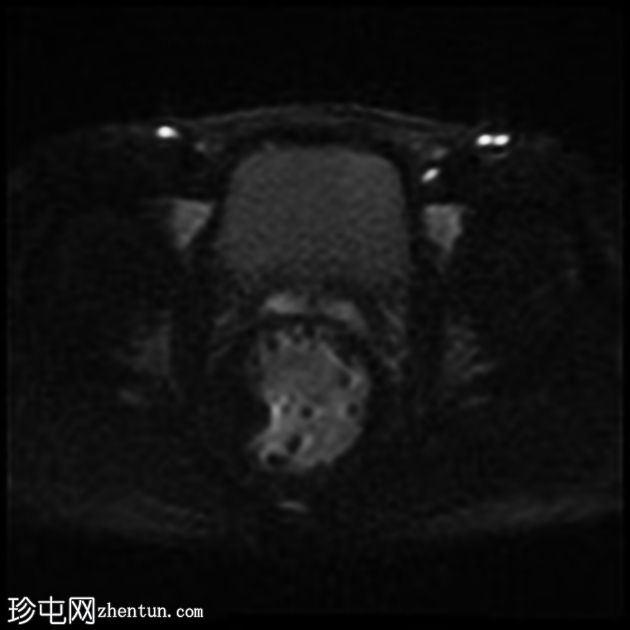 深部囊性结肠炎