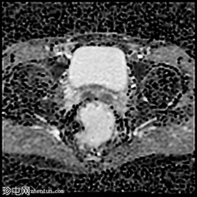 深部囊性结肠炎