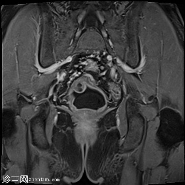 深部囊性结肠炎