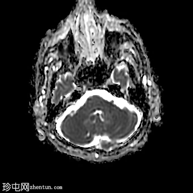 面丘综合征