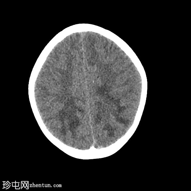 X连锁肾上腺脑白质营养不良