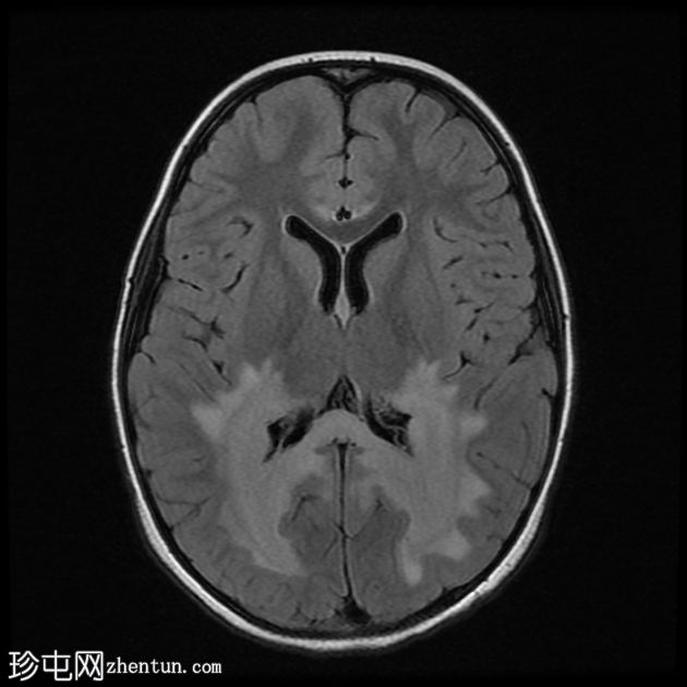 X连锁肾上腺脑白质营养不良