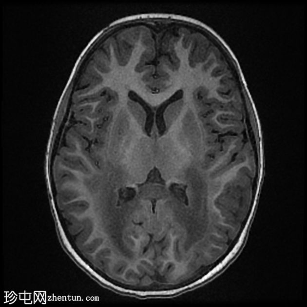 X连锁肾上腺脑白质营养不良