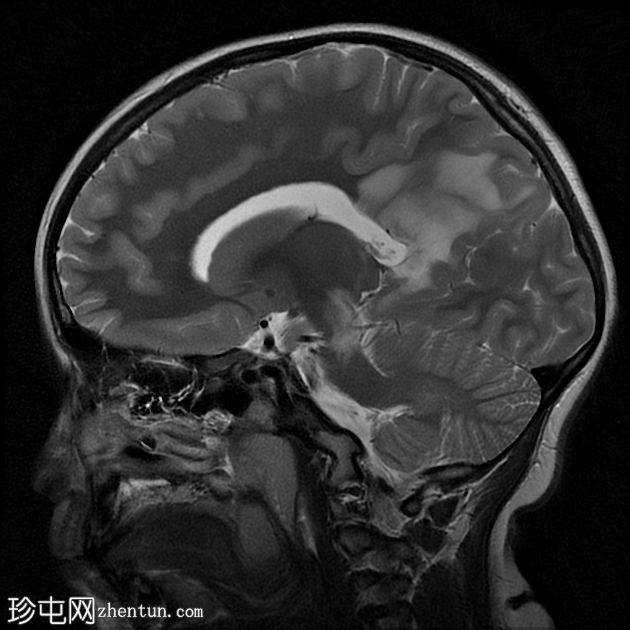 X连锁肾上腺脑白质营养不良