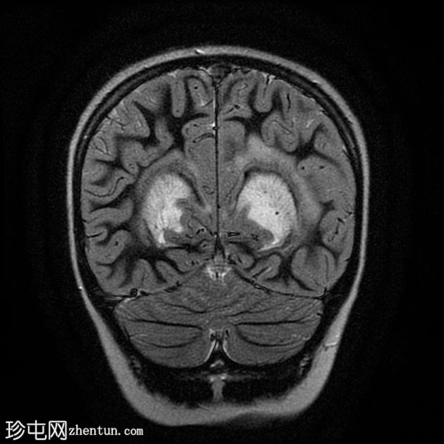 X连锁肾上腺脑白质营养不良