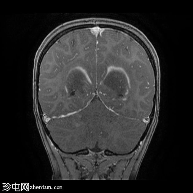 X连锁肾上腺脑白质营养不良