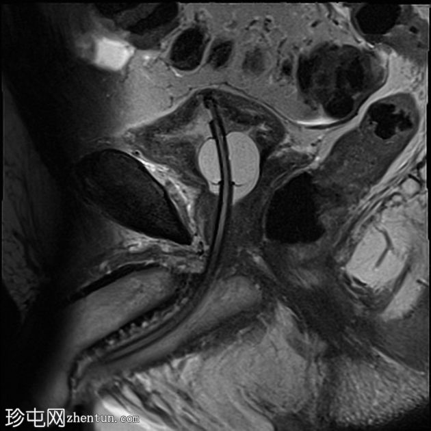 前列腺癌-导管腺癌