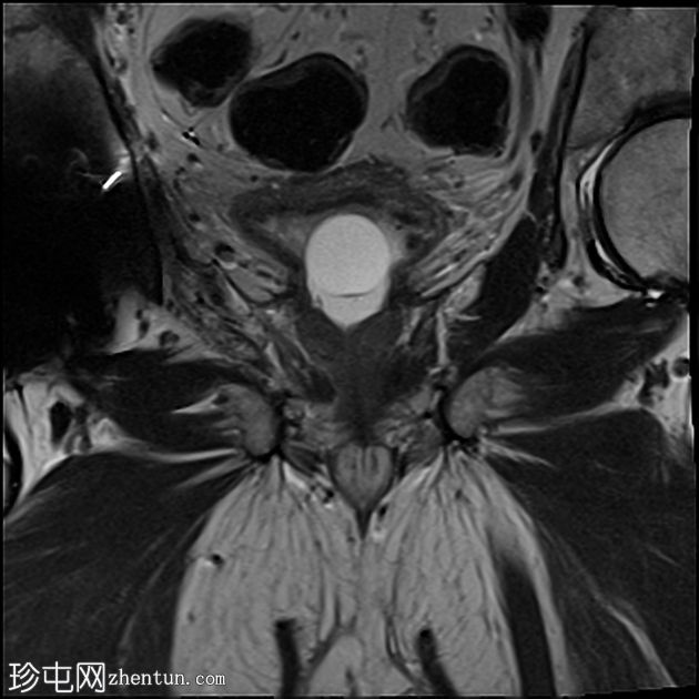 前列腺癌-导管腺癌