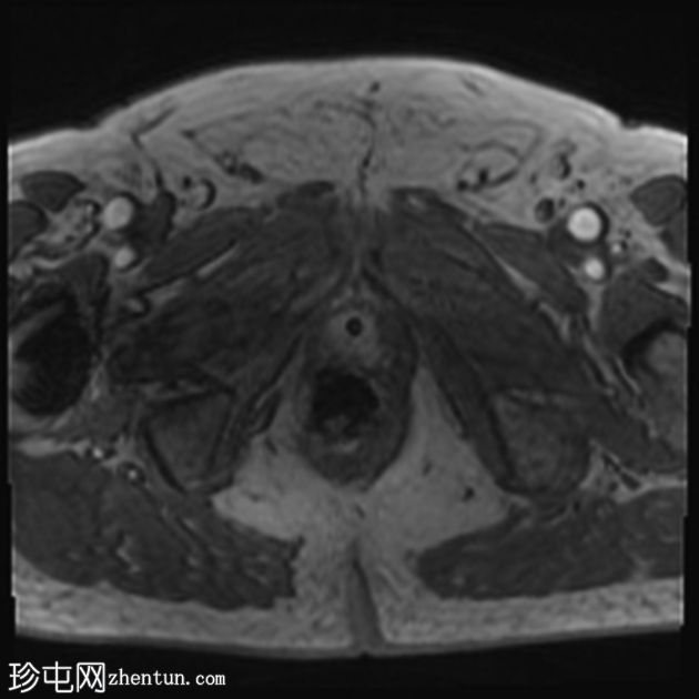 前列腺癌-导管腺癌