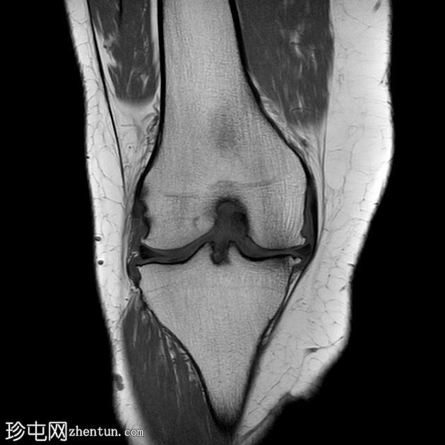 前交叉韧带粘液变性