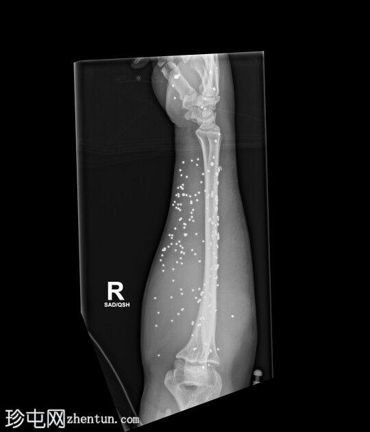 双上肢霰弹枪伤