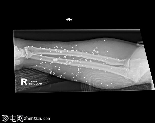 双上肢霰弹枪伤