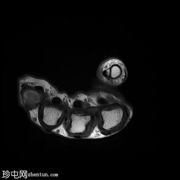 腱鞘巨细胞瘤 - 拇指远端指骨