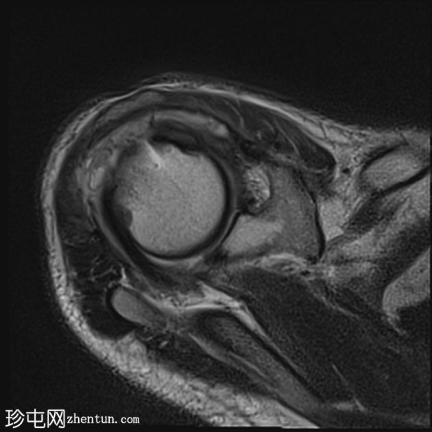 关节镜肩袖修复术后盂肱关节化脓性关节炎