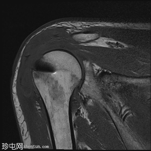 关节镜肩袖修复术后盂肱关节化脓性关节炎