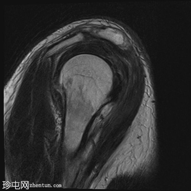 关节镜肩袖修复术后盂肱关节化脓性关节炎