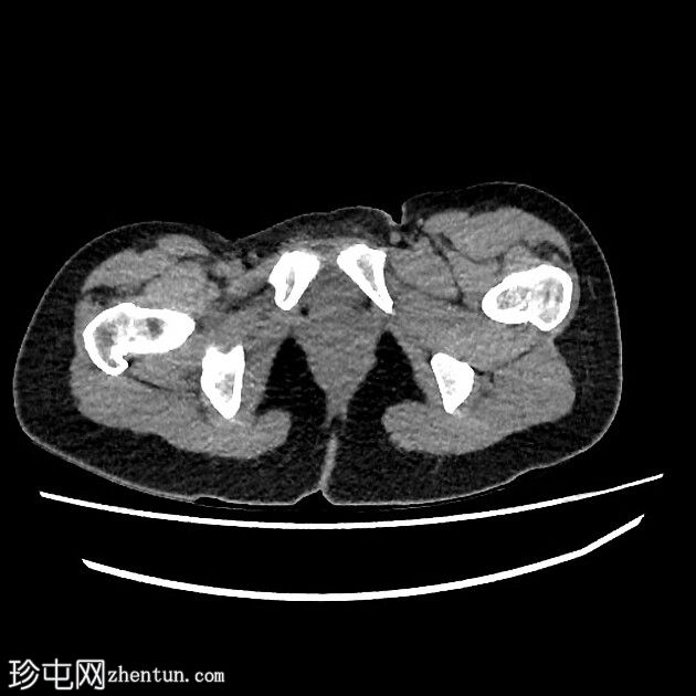 弹响髋综合征