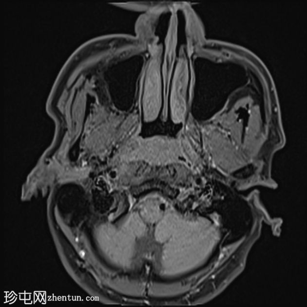 鼻咽癌