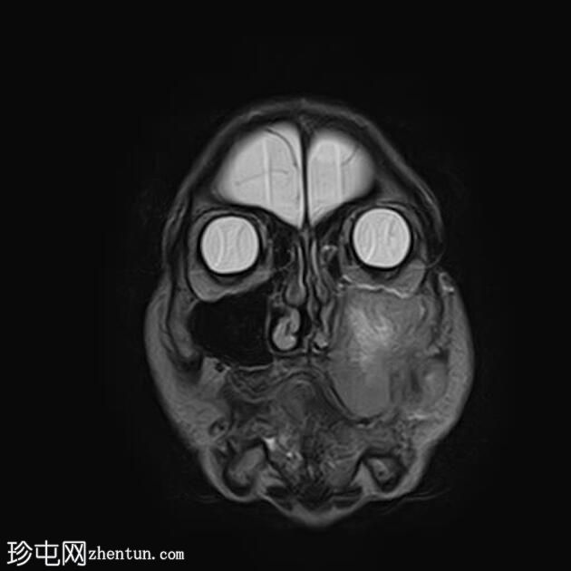 上颌窦腺样囊性癌