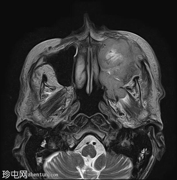 上颌窦腺样囊性癌