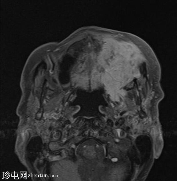 上颌窦腺样囊性癌