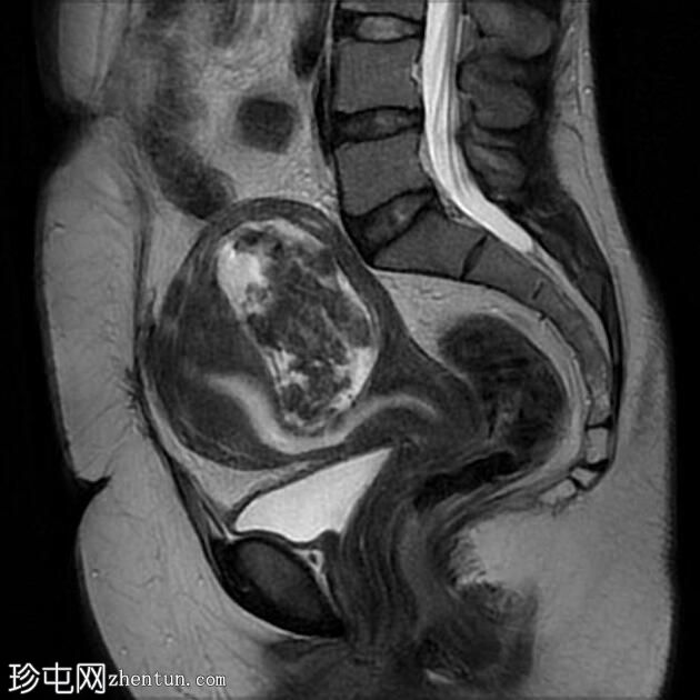 伴有囊性变性的子宫平滑肌瘤