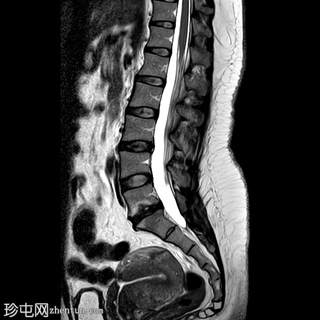 剖腹产疤痕龛