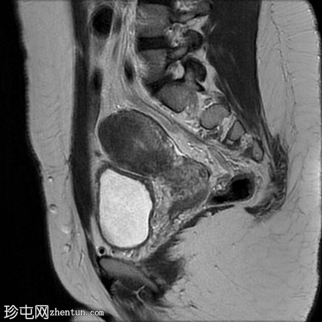 局灶性子宫腺肌病伴卵巢子宫内膜异位症