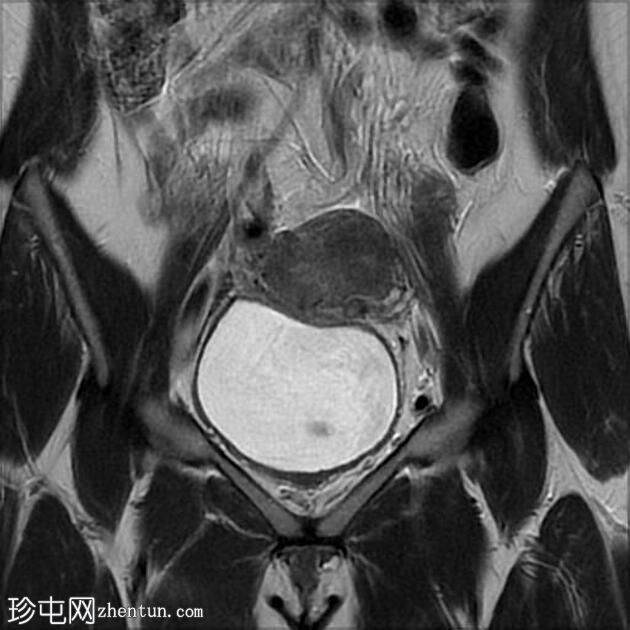 局灶性子宫腺肌病伴卵巢子宫内膜异位症