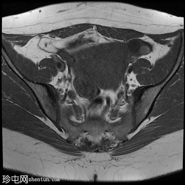 局灶性子宫腺肌病伴卵巢子宫内膜异位症