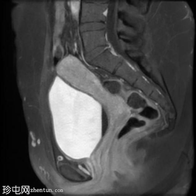 局灶性子宫腺肌病伴卵巢子宫内膜异位症