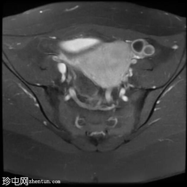 局灶性子宫腺肌病伴卵巢子宫内膜异位症