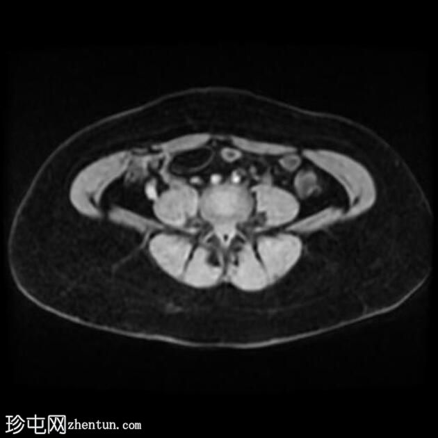 局灶性子宫腺肌病伴卵巢子宫内膜异位症